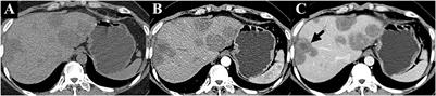 Case report: Successful treatment with the combined therapy of interferon-alpha 2b and anlotinib in a patient with advanced hepatic epithelioid hemangioendothelioma